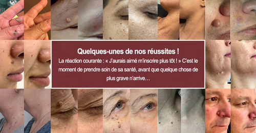 ✨Curalona® Patch micro-aiguilles et hydrocolloïde 2 en 1🍀 | Élimine les grains de beauté en relief, l'acné, les verrues planes et les acrochordons | Atténue les rides, les cicatrices et les imperfections | Patchs invisibles pour le visage et le corps.