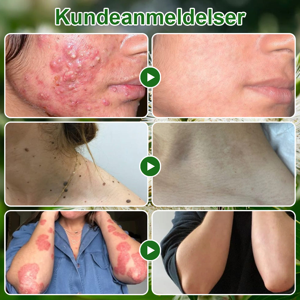 ✅Crème de soin Celsiora® à l'huile d'arbre à thé : élimine les imperfections, répare la peau abîmée, illumine le teint et offre une action anti-âge ❤️‍🔥