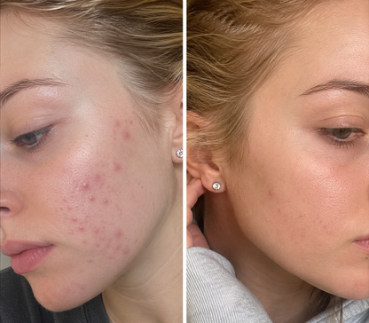 🔥【Boutique Officielle】PURELORA® Spray Corporel 4-en-1 — Anti-Acné · Atténue les Marques · Lisse les Imperfections · Brume Exfoliante | Acide Salicylique + Menthol + Caféine + Huile d’Arbre à Thé | Fabriqué en France