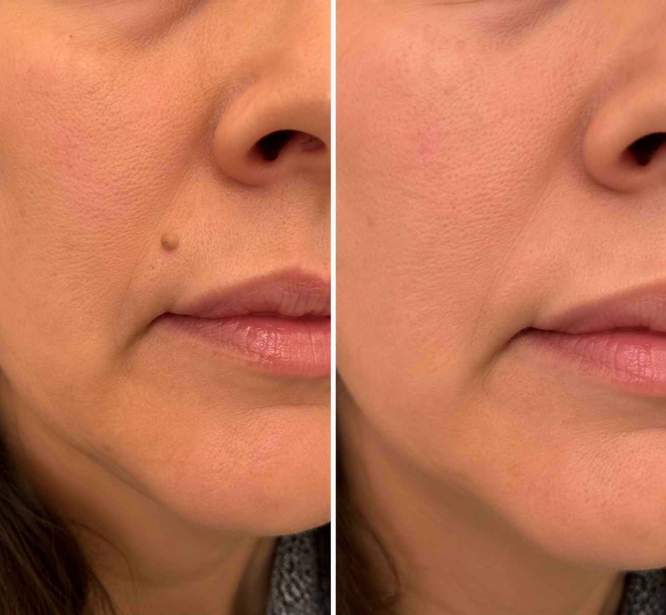 ✨Curalona® Patch micro-aiguilles et hydrocolloïde 2 en 1🍀 | Élimine les grains de beauté en relief, l'acné, les verrues planes et les acrochordons | Atténue les rides, les cicatrices et les imperfections | Patchs invisibles pour le visage et le corps