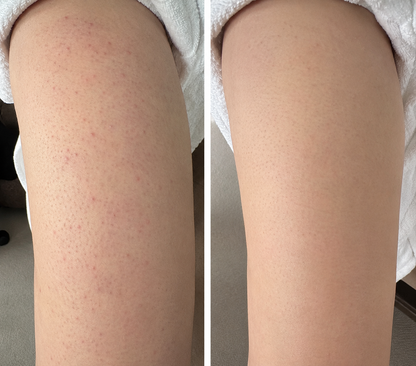 🔥【Boutique Officielle】PURELORA® Spray Corporel 4-en-1 — Anti-Acné · Atténue les Marques · Lisse les Imperfections · Brume Exfoliante | Acide Salicylique + Menthol + Caféine + Huile d’Arbre à Thé | Fabriqué en France